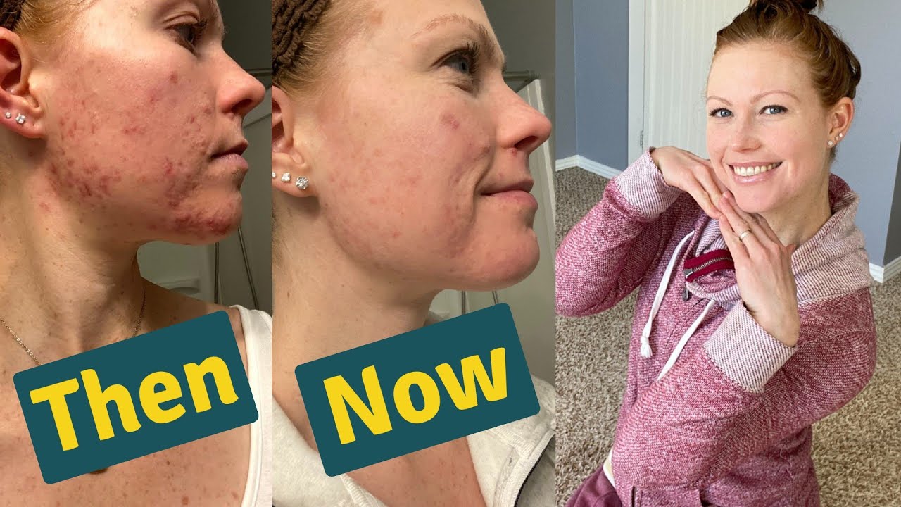 My Acne Skin Care Routine 2021 | How I'm Clearing My Hormonal Acne and Healing My Skin