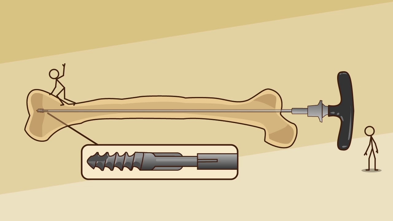 Fassier-Duval Rescue System by OrthoPediatrics Canada