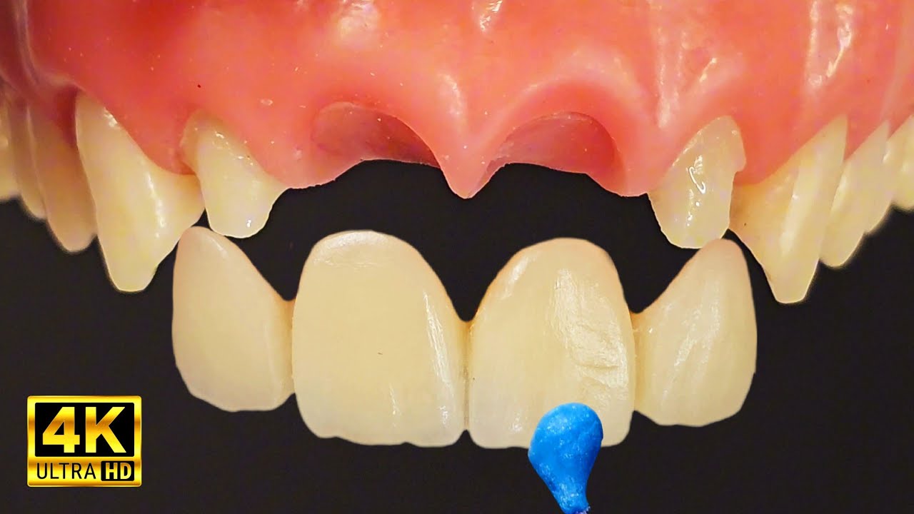 Incredible Smile Reconstruction With Dental Bridge