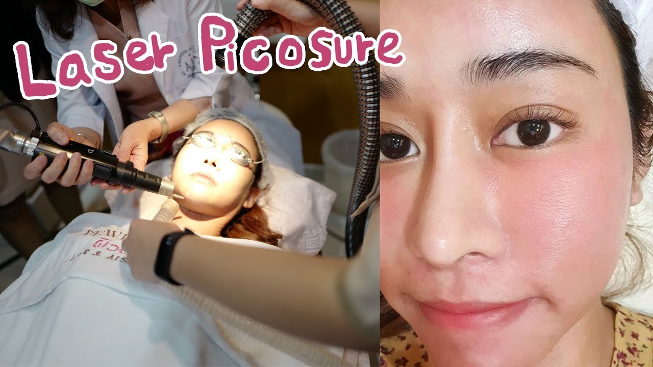 ลองทำเลเซอร์หน้าที่ดีที่สุดในตอนนี้!!  PICOSURE