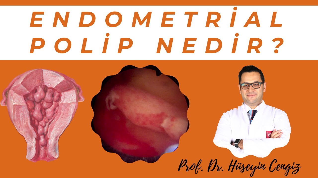 ENDOMETRİAL POLİP NEDİR?💥  (Rahim i&ccedil;i polip ve tedavisi)