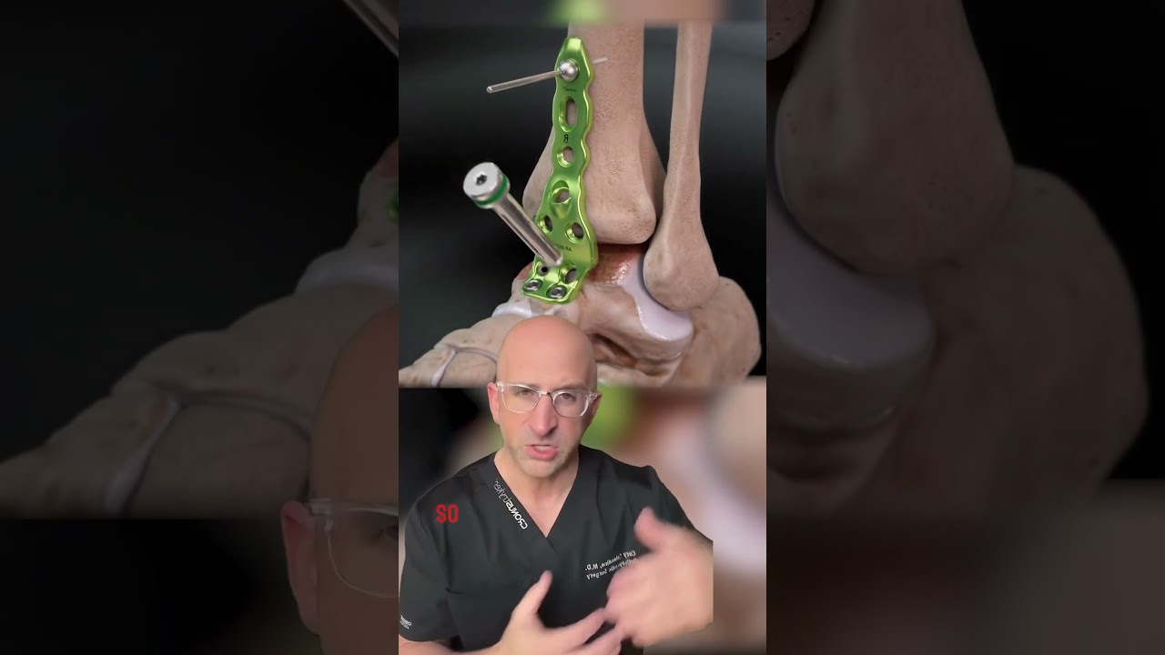 Ankle Bone-on-Bone Pain Solution #shorts #arthritis