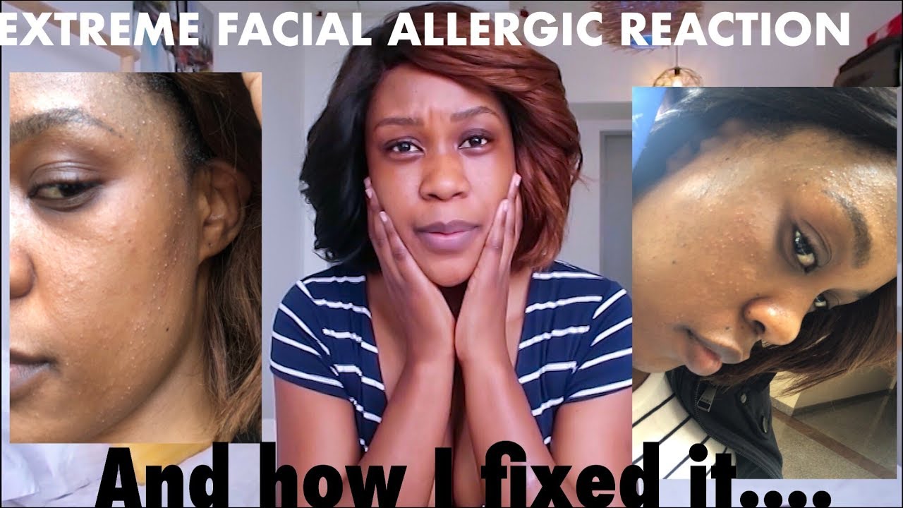 EXTREME FACIAL ALLERGIC REACTION AND HOW I FIXED IT || STORYTIME