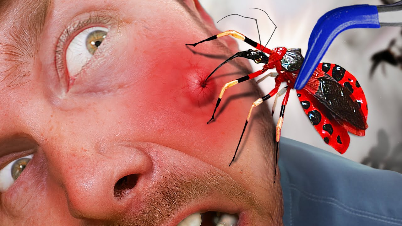 Bitten by Parasitic Assassin Bug! ( Sends Me to the Hospital)