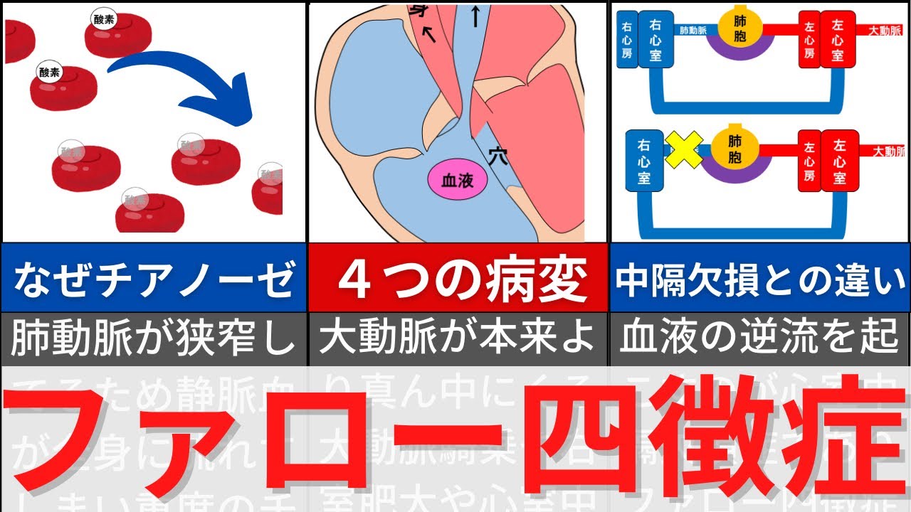 【7分で解説、20分で国試問題】ファロー四徴症について解説