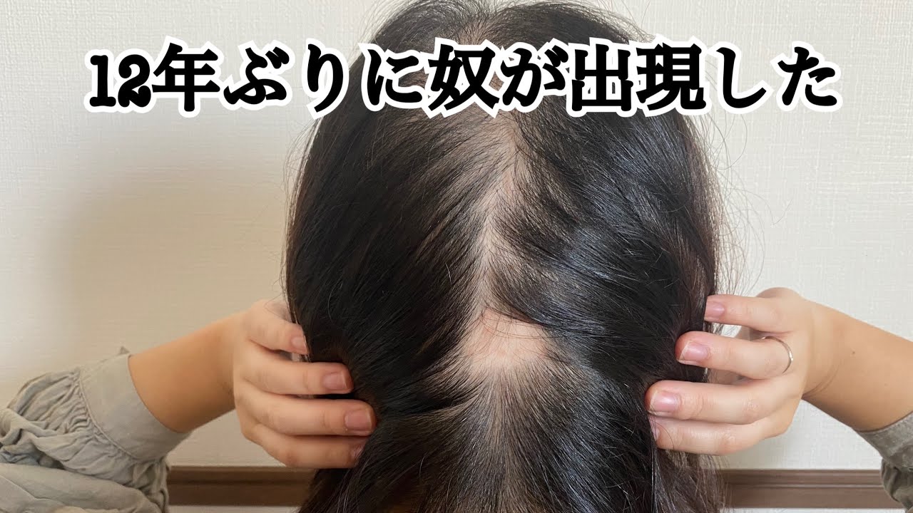 12年ぶりに円形脱毛症ができて喜んだ女が私です。