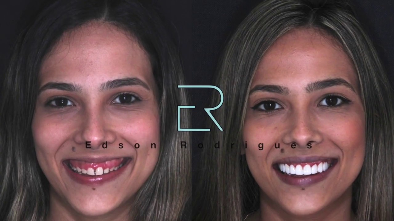 Lentes de Resina - Caso Beatriz