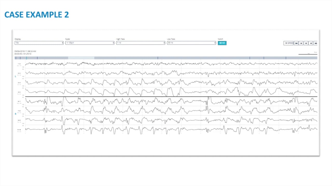 EEG Atlas B4: Real-world EEG Cases Using The Ceribell Rapid Response System