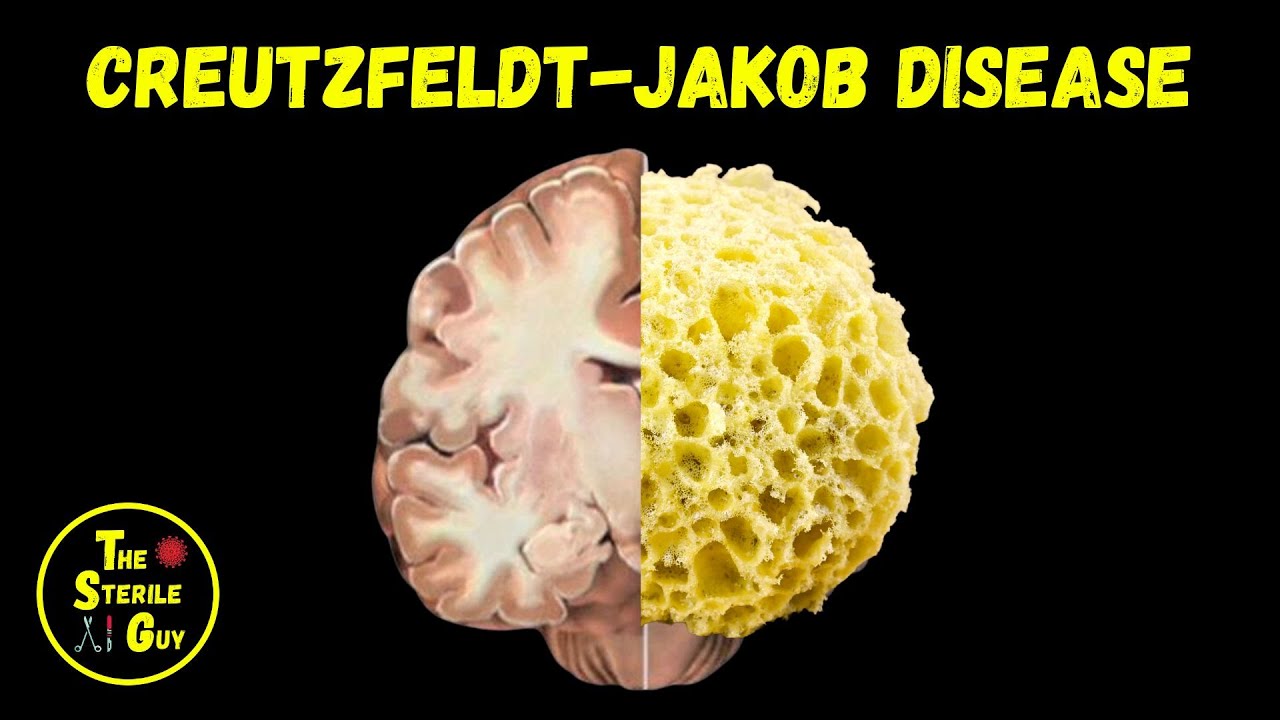 What is CJD?  |  Creutzfeldt-Jakob Disease  |  Prions