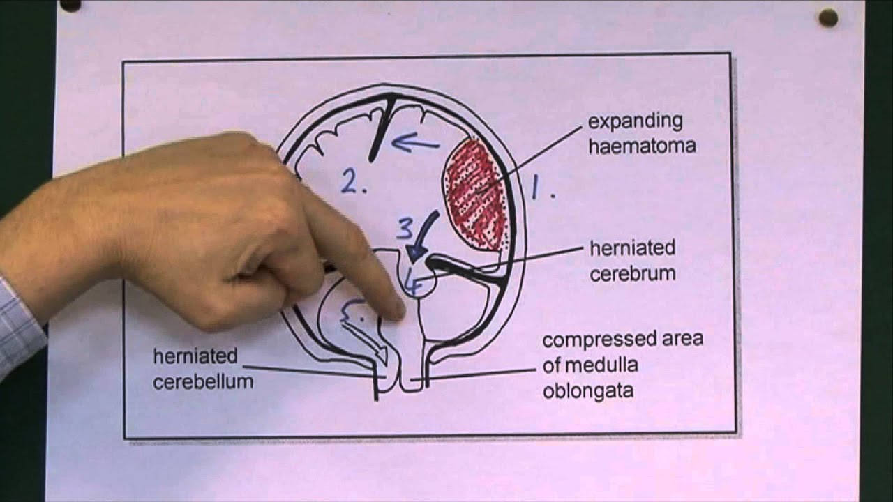Head Injuries 9, Tentorial herniation