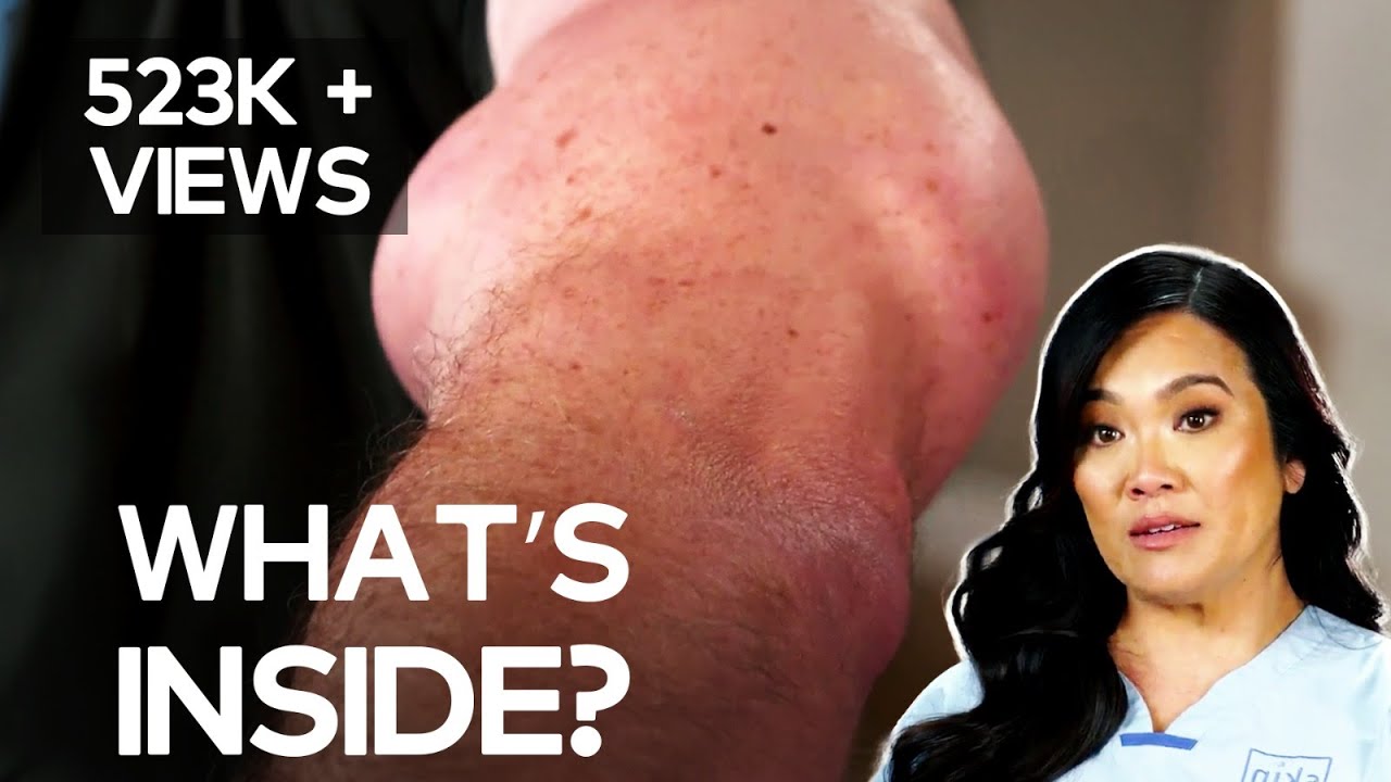 Hanging by a Thread? | Dr. Pimple Popper TLC