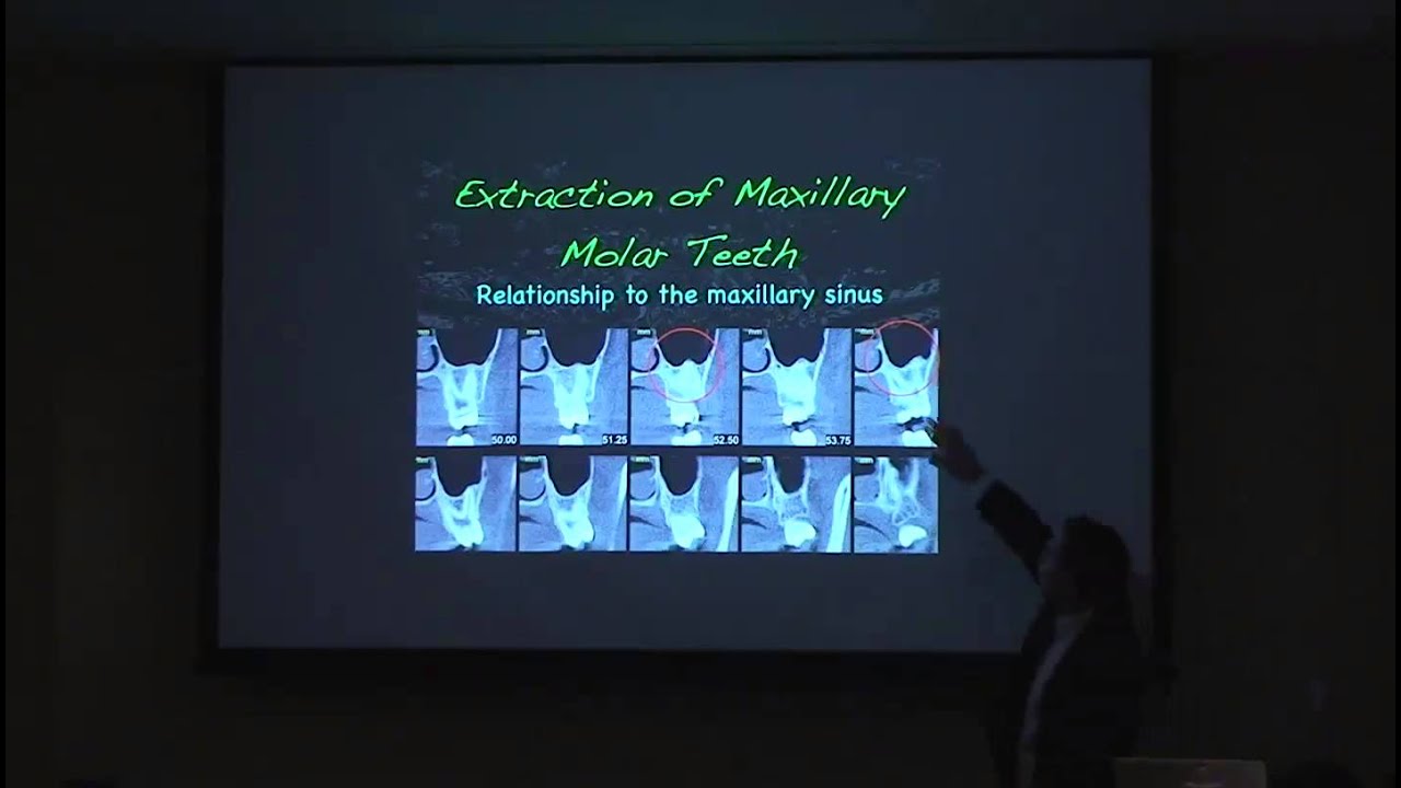 August Lecture Part 1: Molar Extraction Techniques - Brent Allan