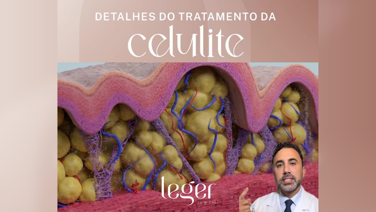 Dr Roberto Chacur explica o tratamento da celulite com GoldIncision