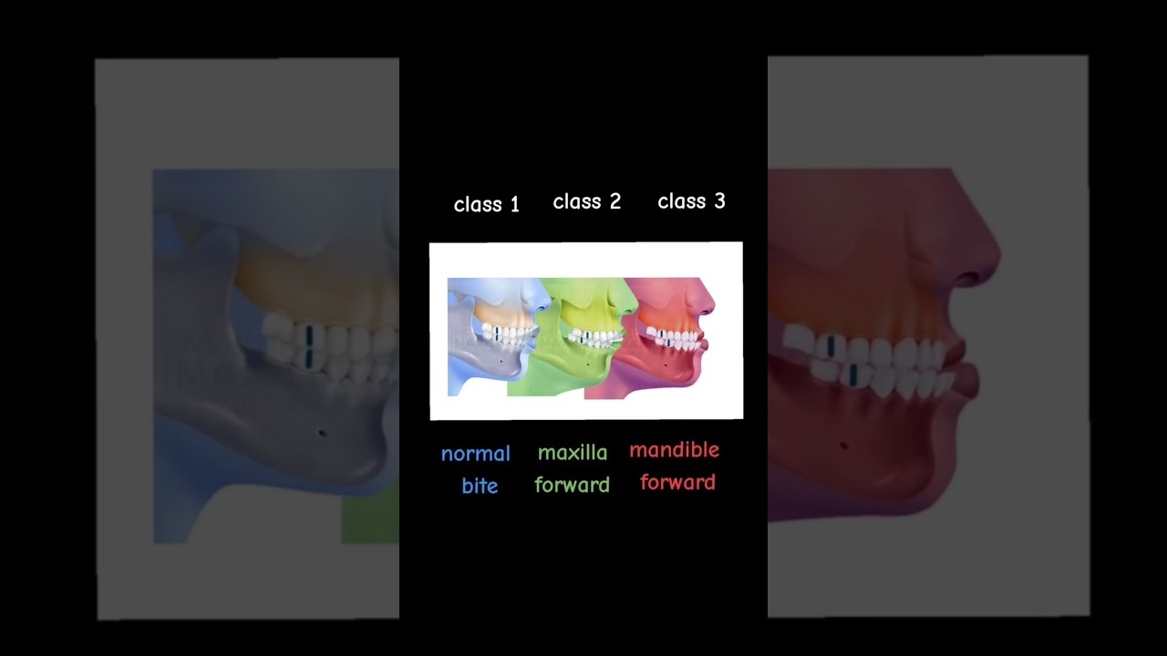Angle&rsquo;s Classification of Malocclusion 🦷✨️ #dentistry #dentist #dental_student  #dental #طب_الاسنان