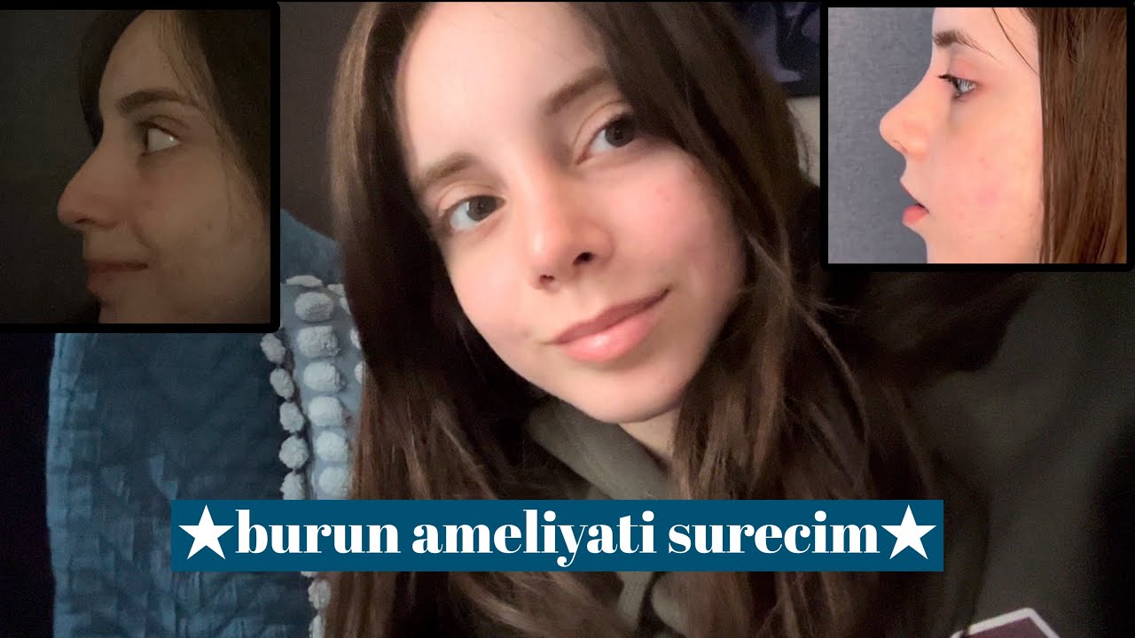 burun ameliyati surecim✨|hastane cantasi hazirlama,neden burun ameliyati oldum, pisman miyim?