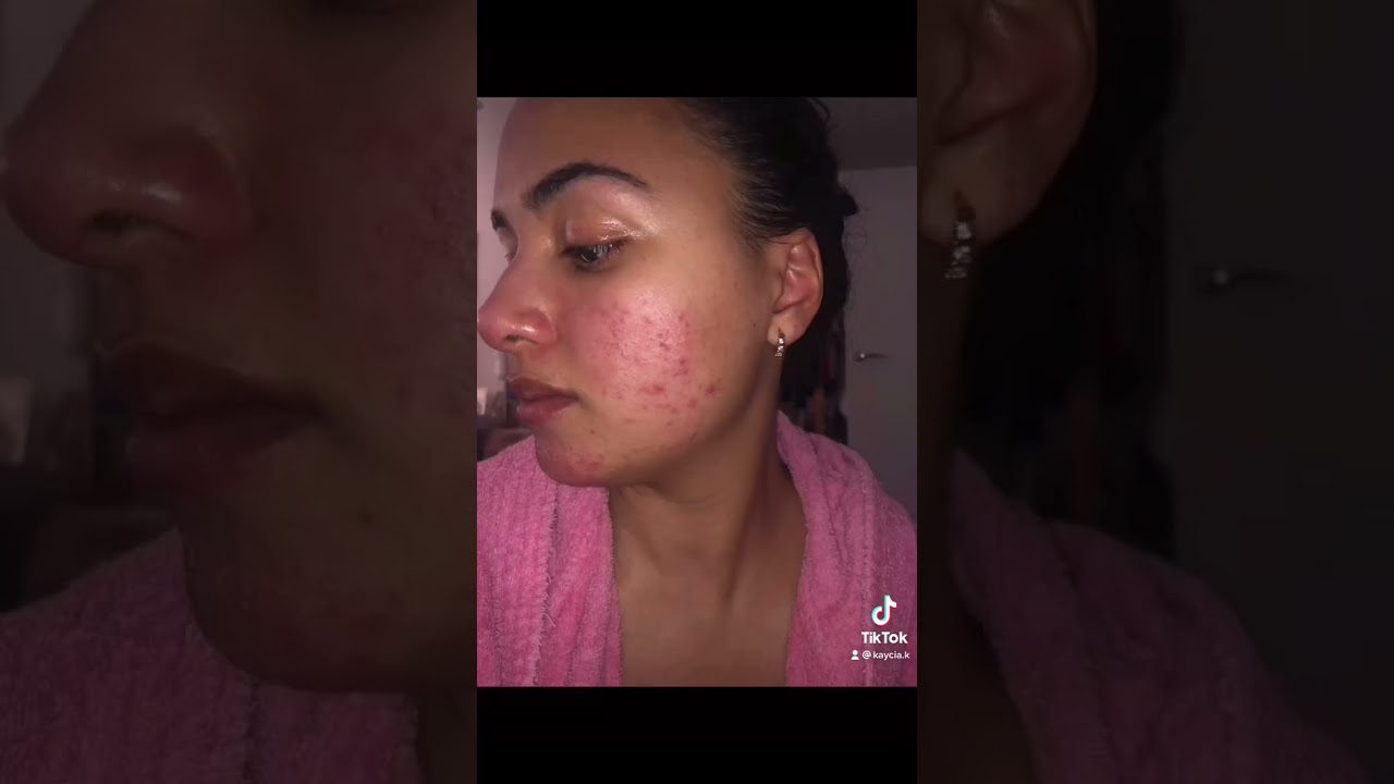 A Snippet of My Acne Journey: Tretinoin 0.05% (2021) Before & After #acne #tretinoin #shorts