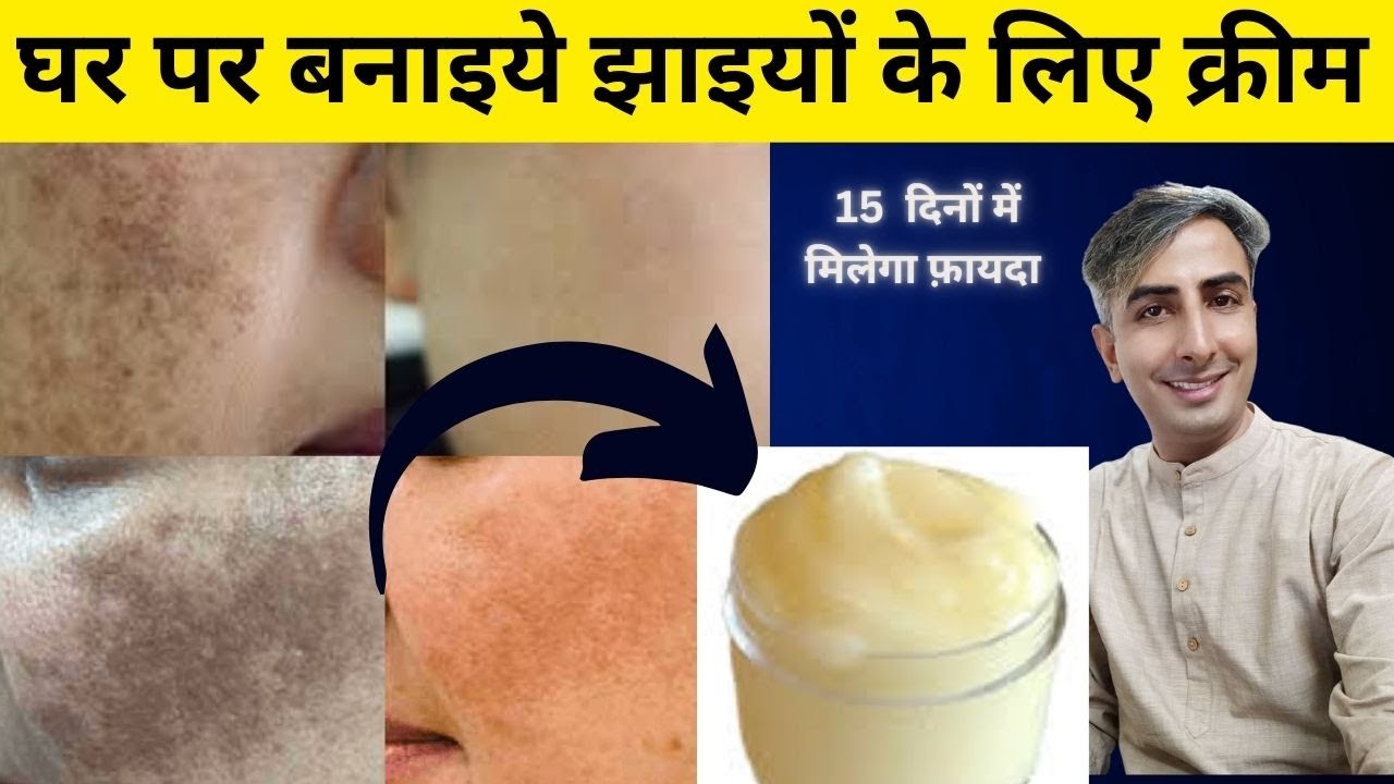 कितनी भी मुश्किल झाइयाँ, MELASMA HYPERPIGMENTATION हों , करें 100% इलाज़ I Dr. Manoj Das