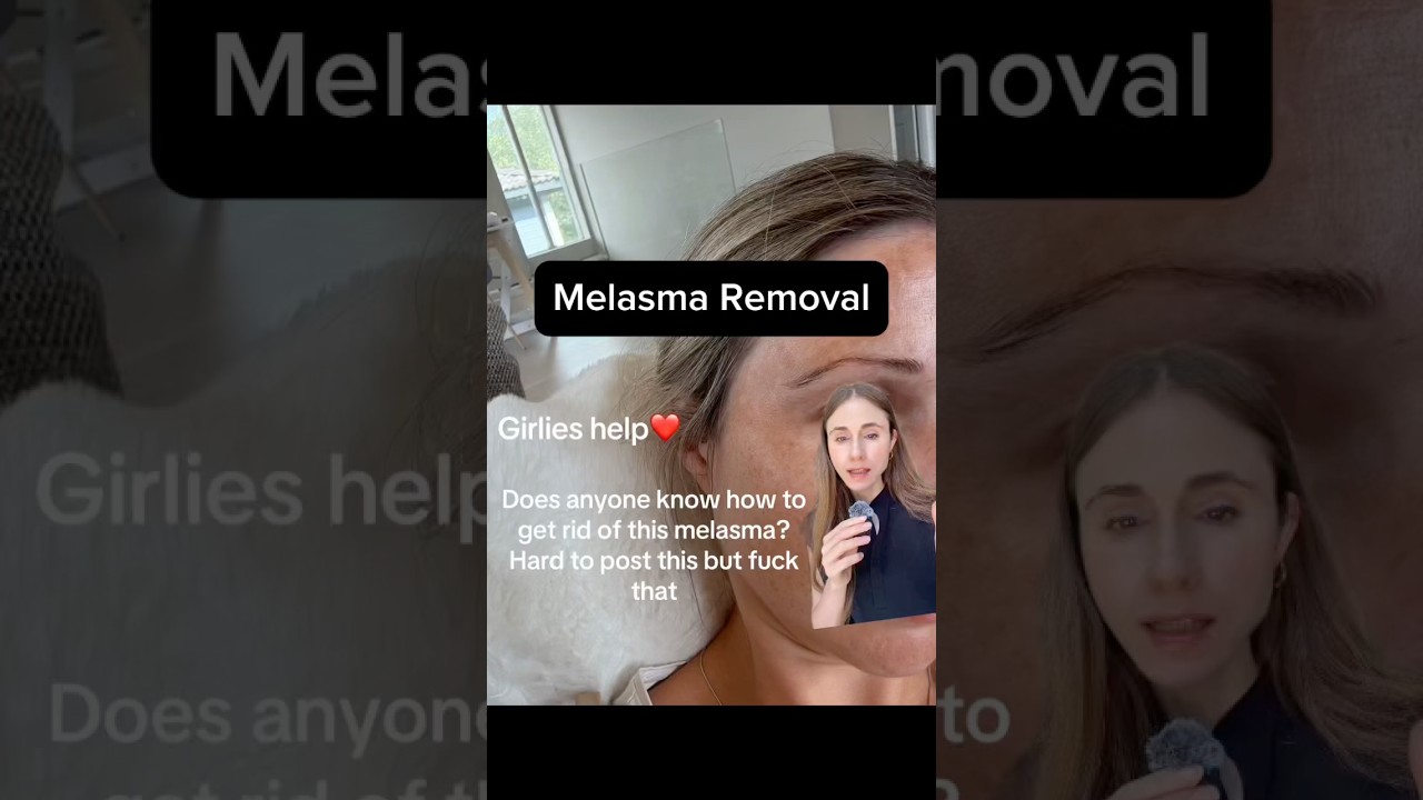 Melasma Removal Hacks YOU NEED TO TRY #dermatologist