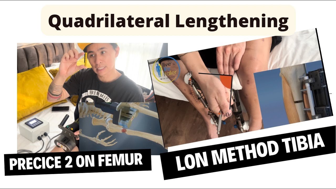 Quadrilateral limb lengthening surgery with Precice and LON method, Femur and Tibia at the same Time