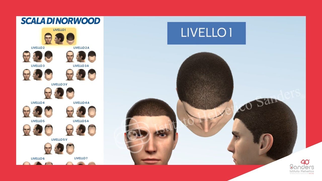 Caduta capelli Uomo: Nuova Scala della calvizie