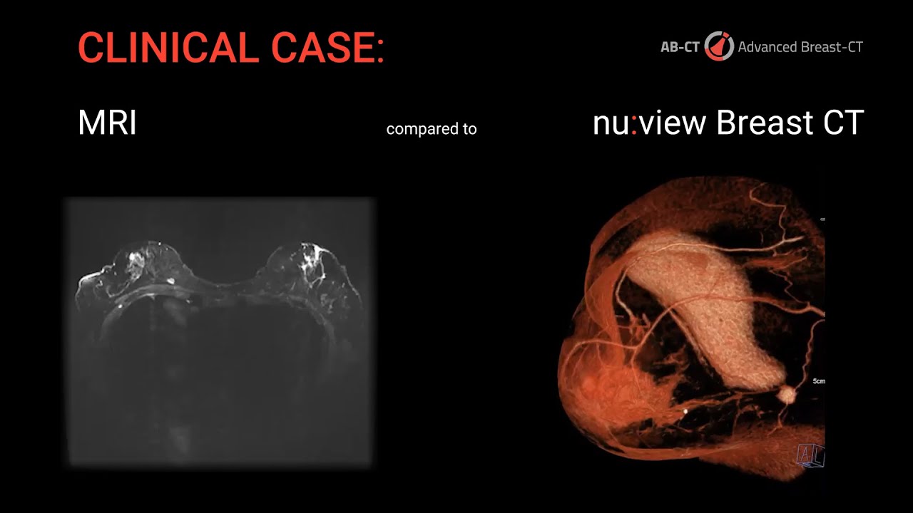 Breast CT in comparison to MRI: The power of nu:view