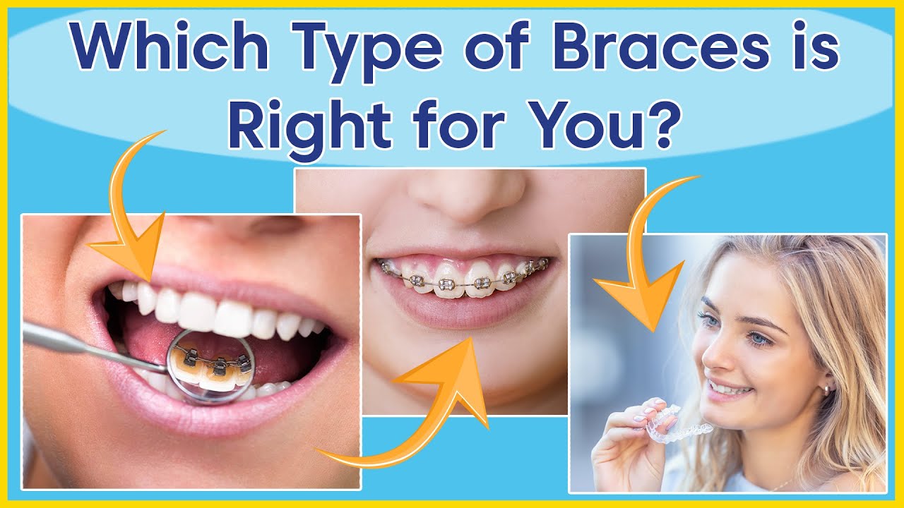 Types Of Orthodontic Treatment | Which Braces Are Right For You?