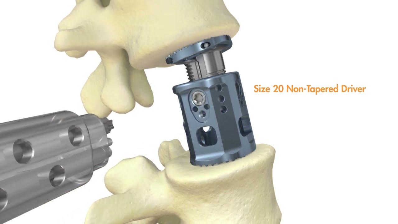 CAPRI Thoracic System - 3D Spinal Implant Animation by Pulse 3D Media