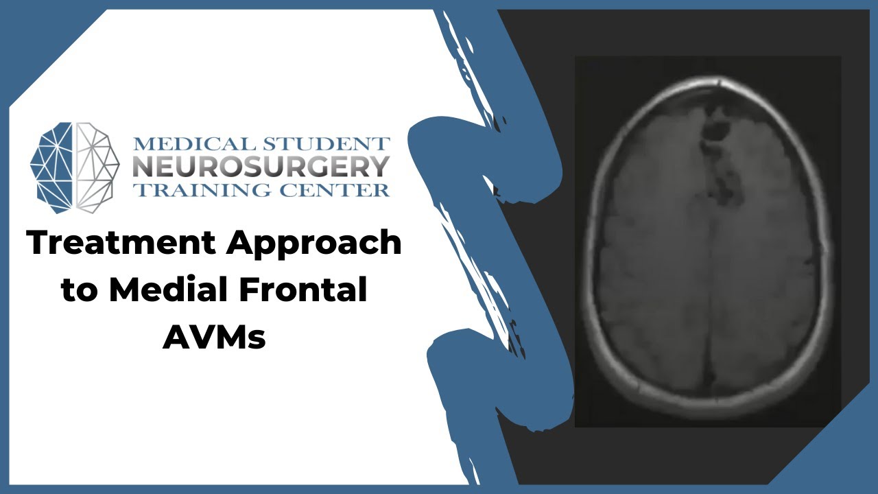 Treatment Approach to Medial Frontal AVMs
