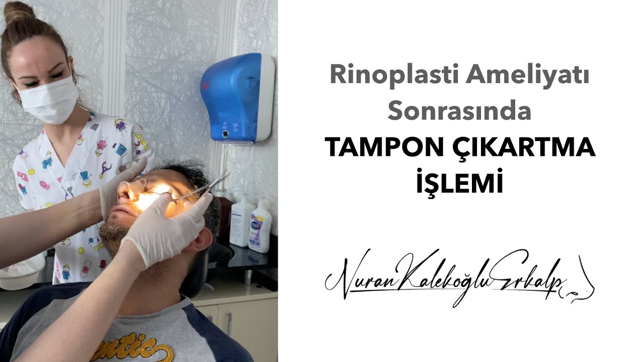 Rinoplasti ameliyat sonrası 'TAMPON ÇIKARTMA' işlemini gerçekleştirdik