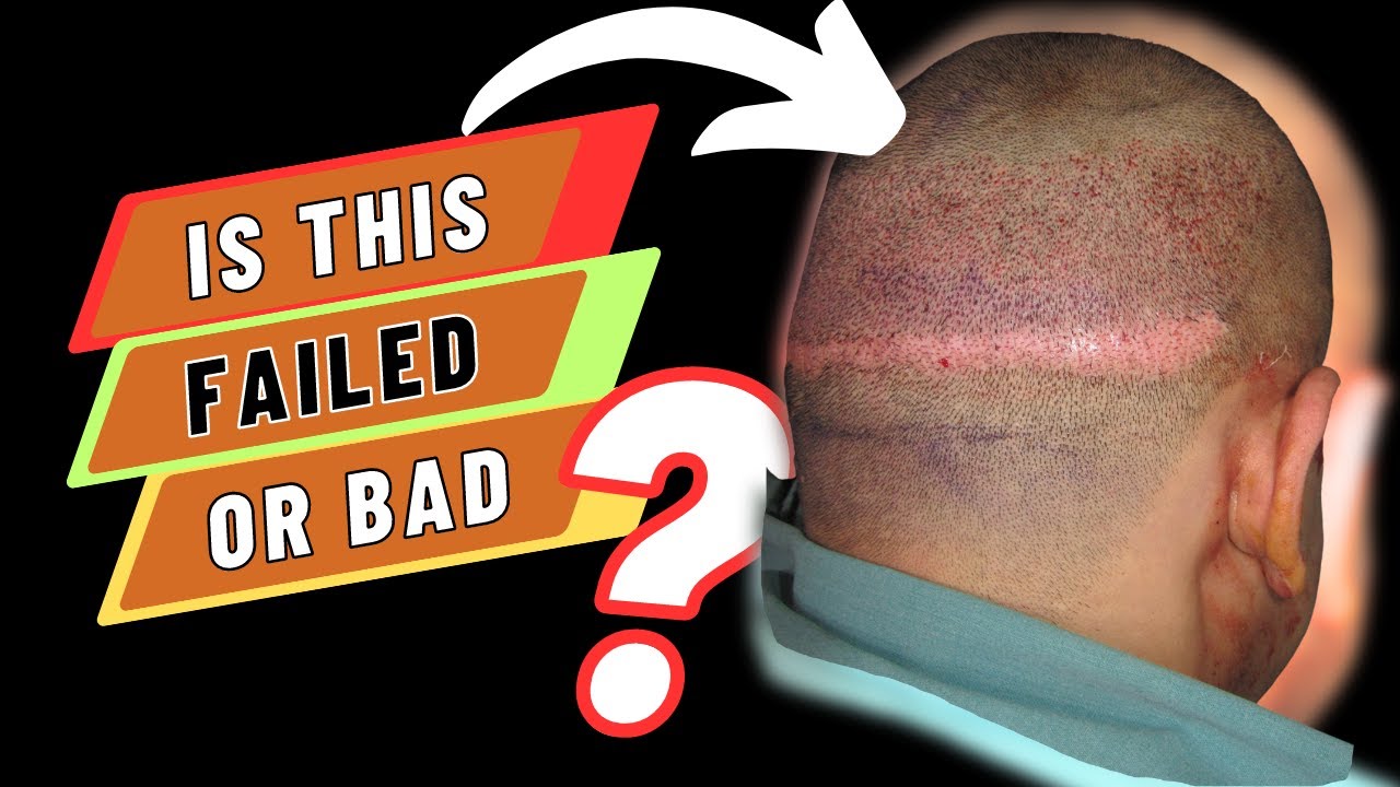 Hair transplant in India for Revision of Failed hair transplant