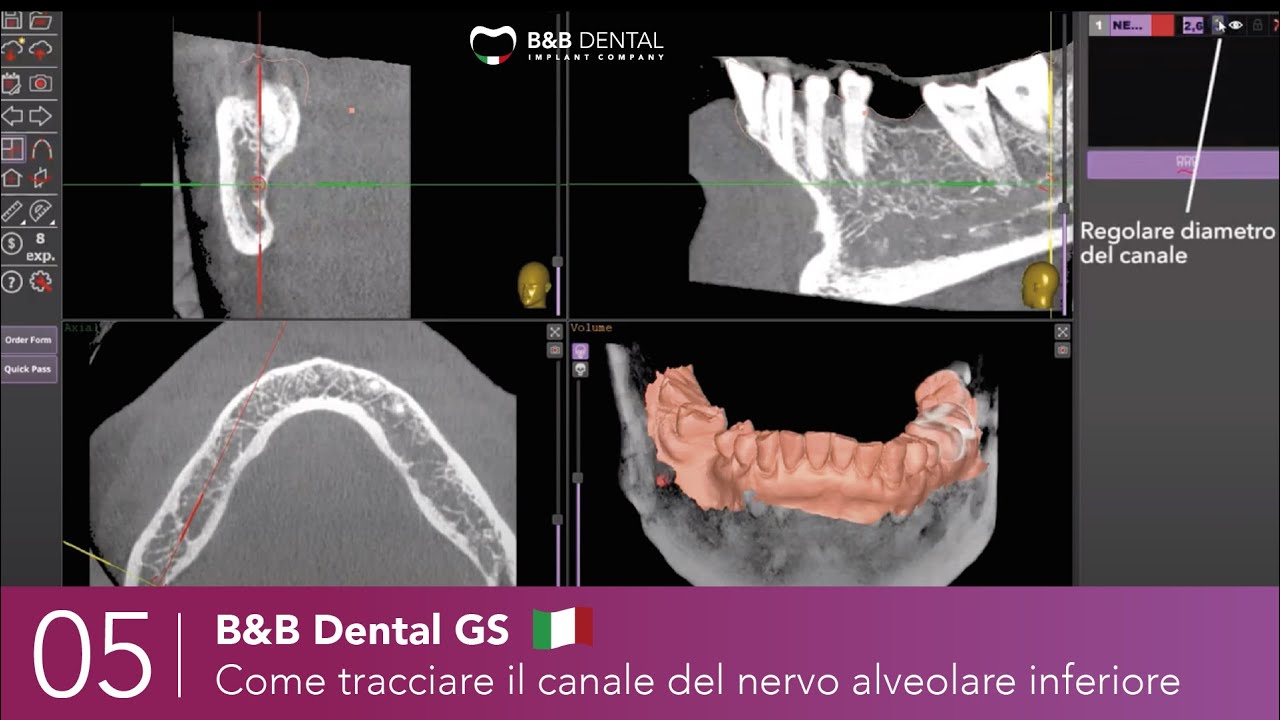 B&B Dental GS - 05 - Come tracciare il canale del nervo alveolare inferiore