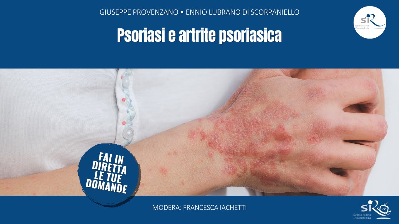 Psoriasi e artrite psoriasica