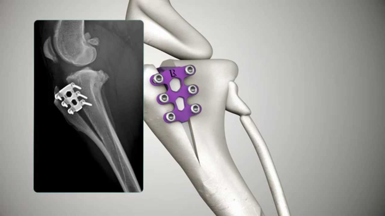 Tibial Tuberosity Advancement: TTA RAPID