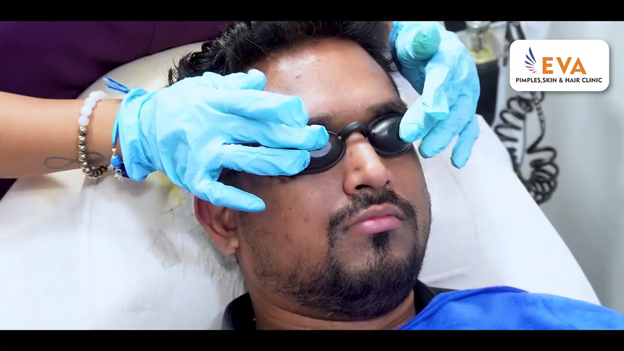 Mesotherapy for Hair Loss | Mesotherapy Complete video 