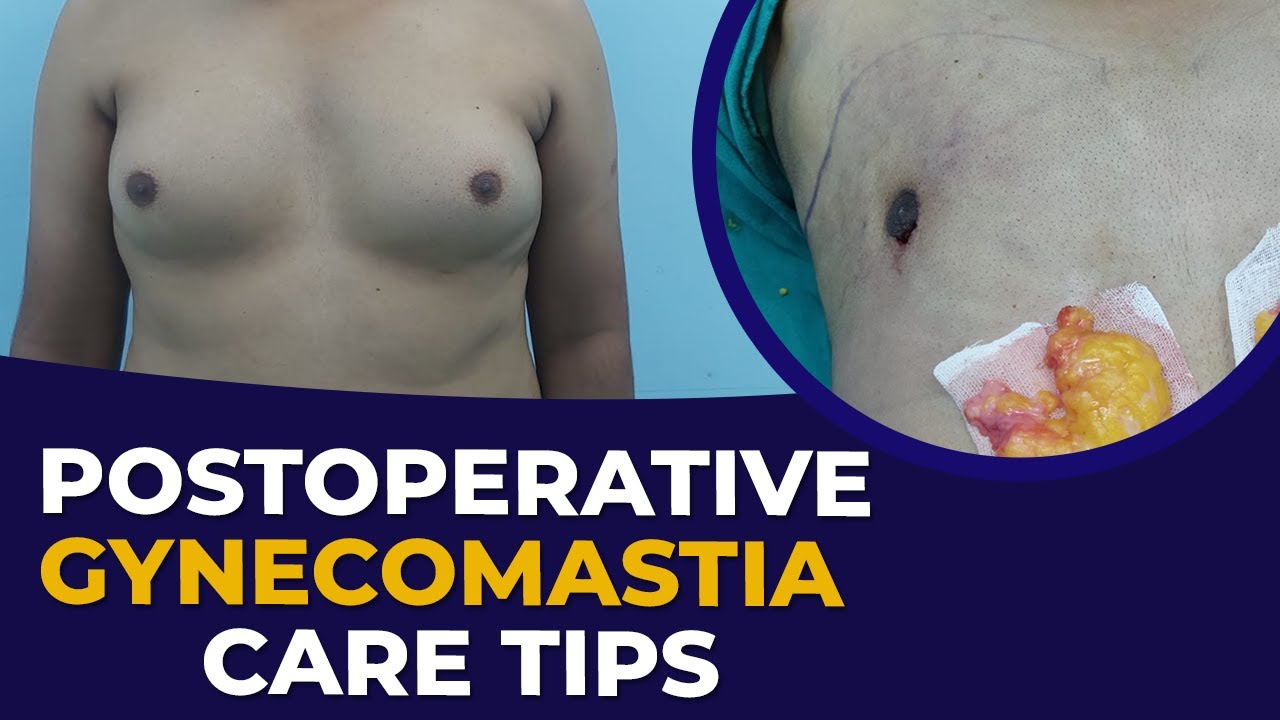 Care After Gynecomastia Surgery | Male Breast Surgery के बाद अपनी देखभाल कैसे करे | By Dr PK Talwar