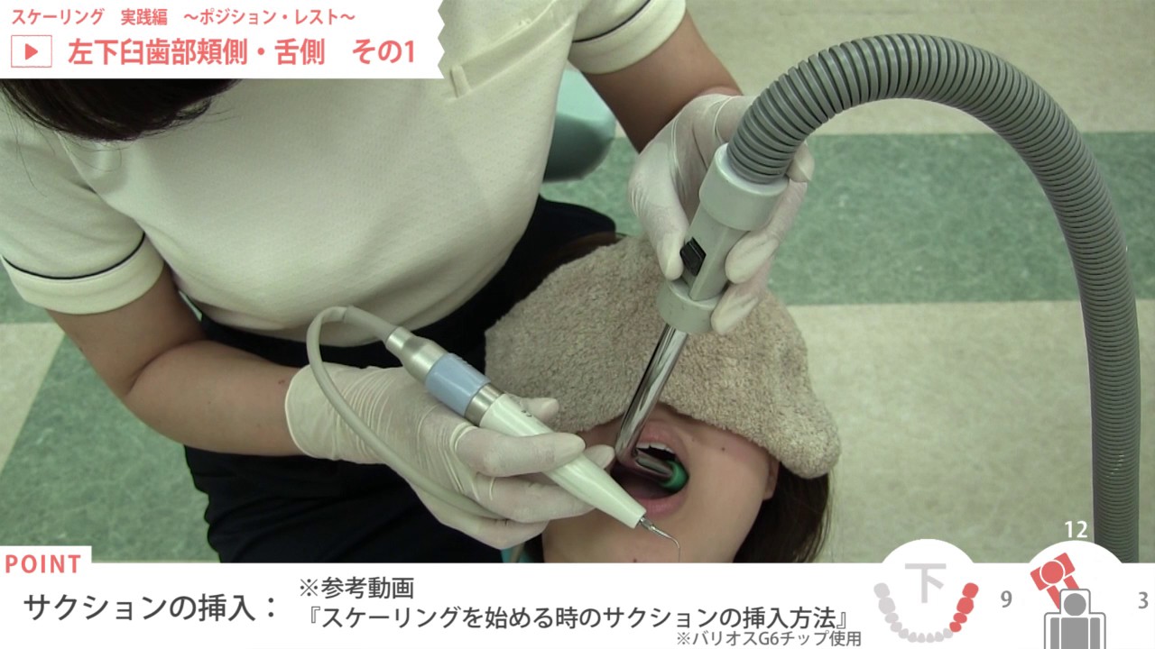 【旧】スケーリング 実践編　01 左下臼歯部頬側・舌側　その1