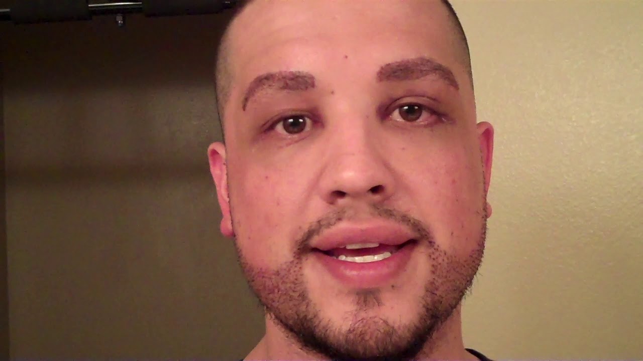 FUE Beard & Eyebrow Hair Transplant Recovery Video Dallas, Texas