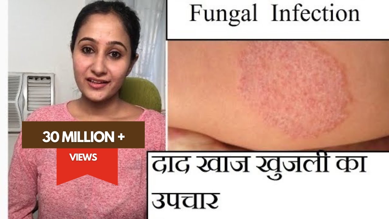 फ़ंगस इनफ़ेक्शन का इलाज || Treating Fungal Infection (In HINDI)|| DR.MADHURI ANANTWAR