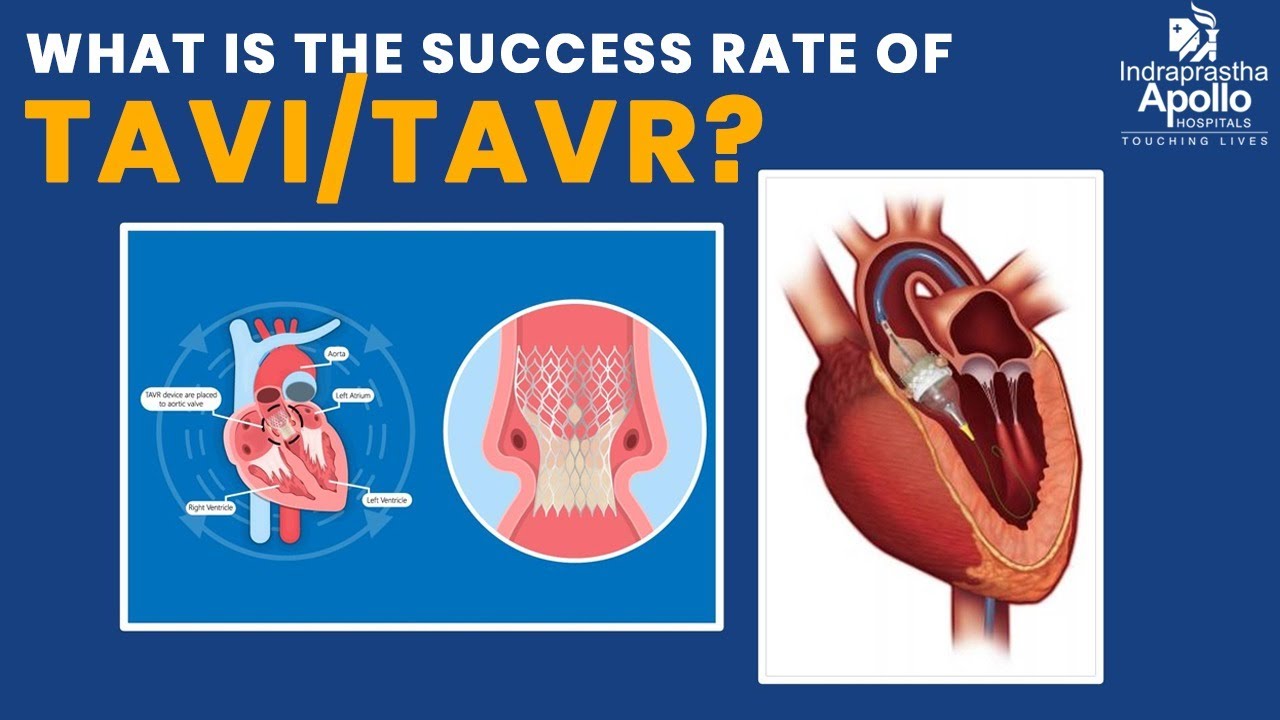 What is the Success Rate of TAVI/TAVR? | Dr. Ranjan Modi | Apollo Hospital