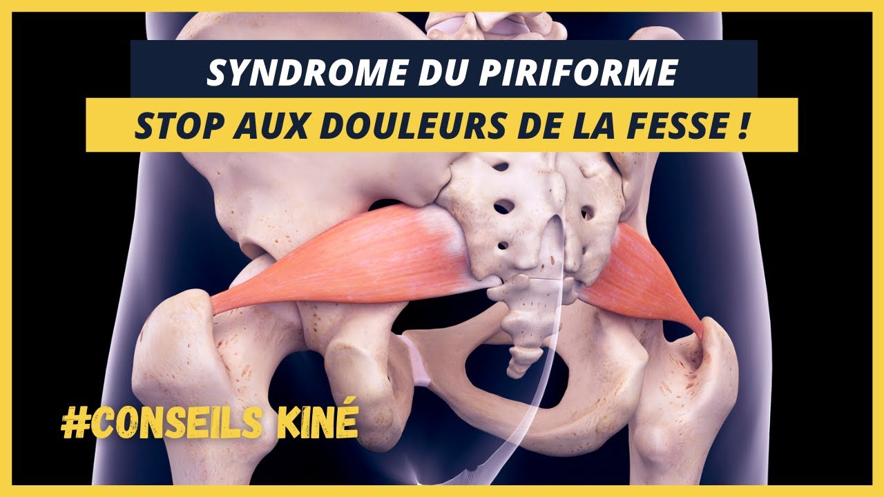 COMMENT SOIGNER SON SYNDROME DU PIRIFORME ? CONSEILS KINÉ !