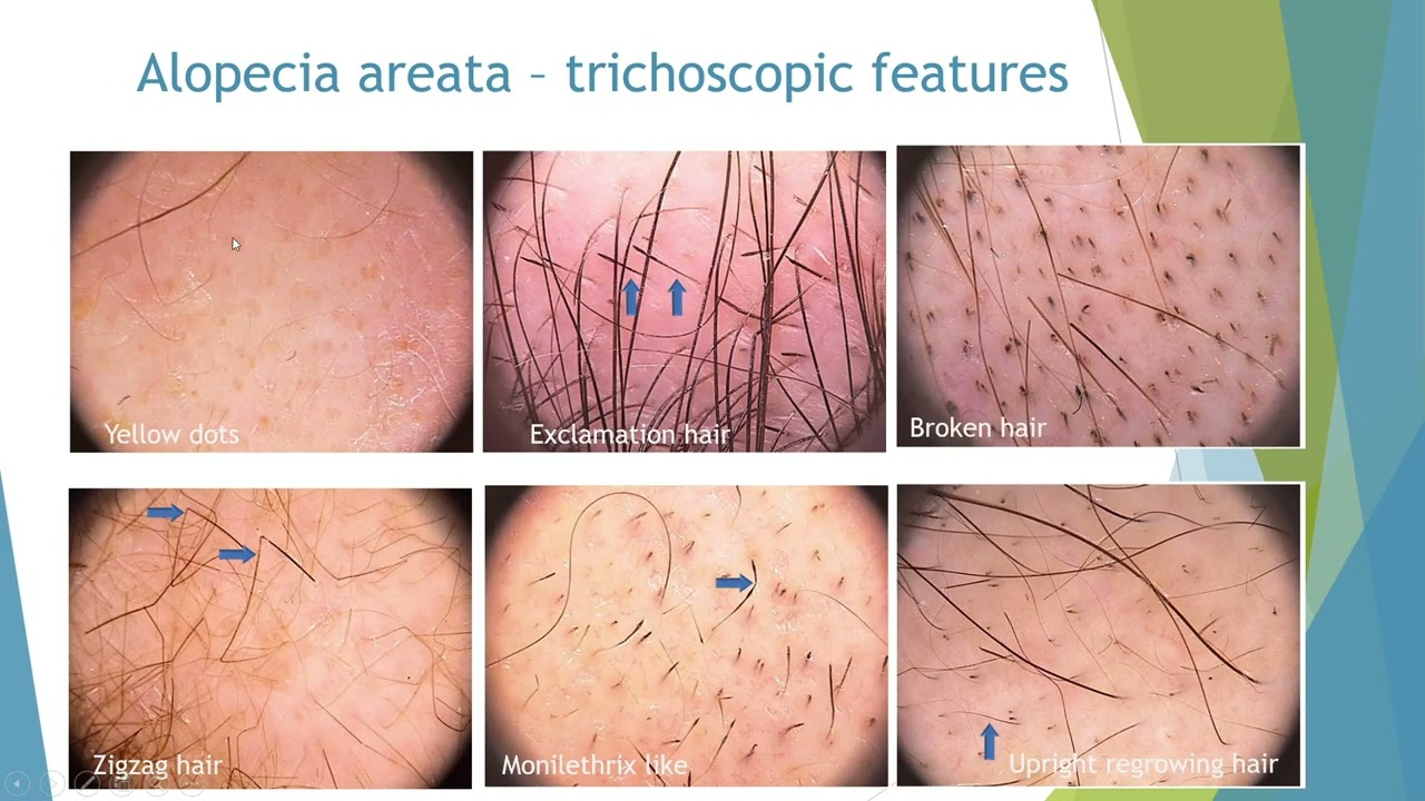 Trichoscopy clues - 1 - Alopecia areata