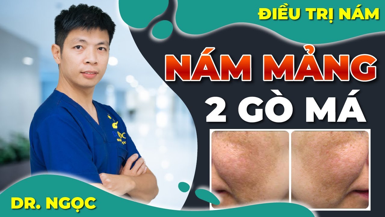 ĐIỀU TRỊ NÁM MẢNG 2 BÊN GÒ MÁ| TREATMENT MELASMA| DR.NGỌC