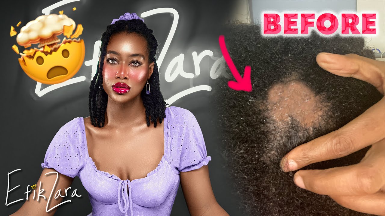 MY HAIR FELL OUT! These Alopecia Remedies GROW IT BACK (4c/b/a Natural Hair) 😭 | EfikZara