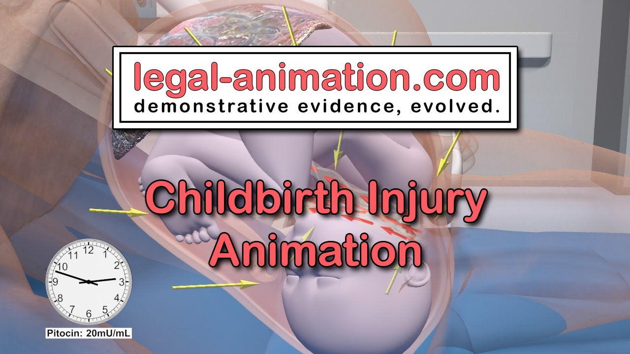 Childbirth Injury Animation. Forensic animation created for Jim M. Perdue, Jr.  Medical Animation.