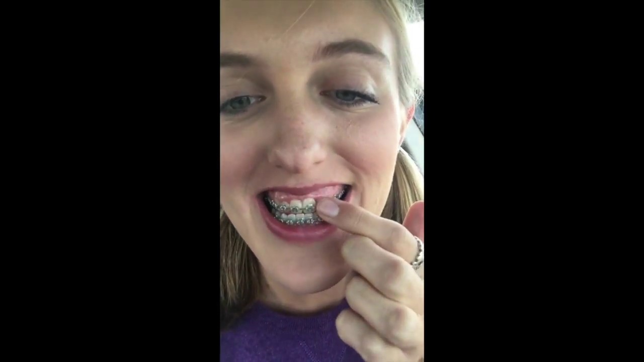 My Double Jaw Surgery Process