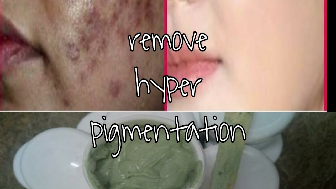 7 days challenge! Remove hyper pigmentation,dark spots and fairness pack