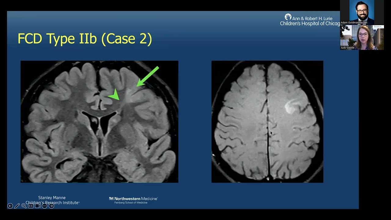 Pediatric Epilepsy Imaging -- Dr. Judy Gadde -- 8.10.20223