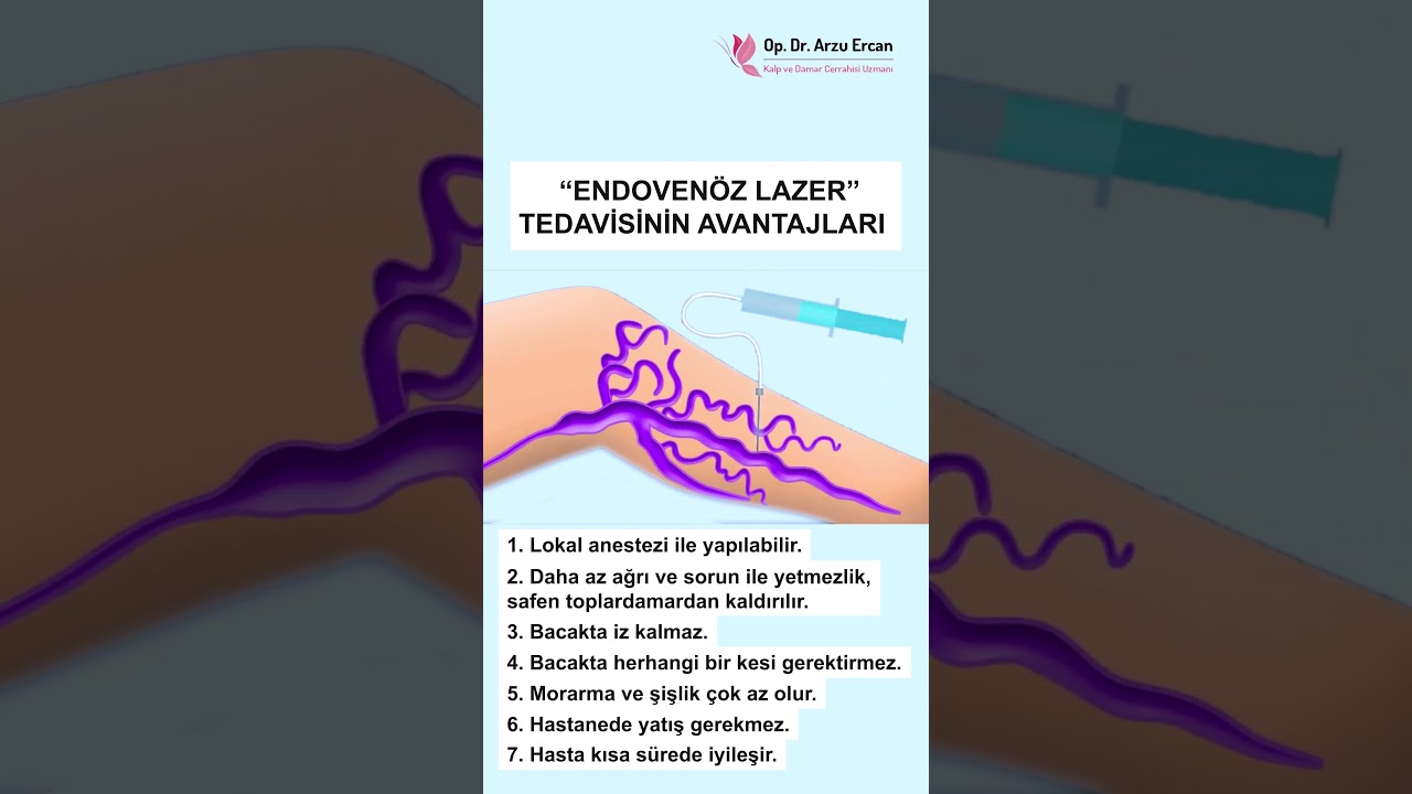 Endoven&ouml;z Lazer Ablasyon Tedavisi #varistedavisi #shortsviral