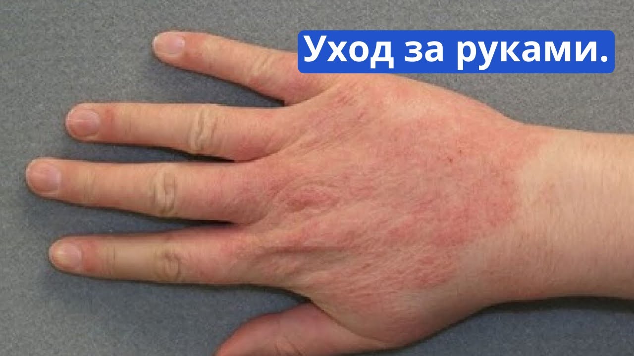 Уход за руками. Экзема на руках. Очень сухая кожа рук.
