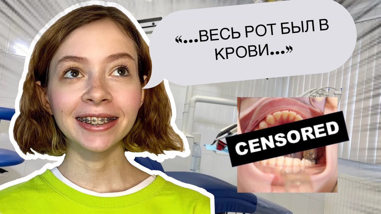 ОДИН ГОД С БРЕКЕТАМИ/ Вытягивание клыка + ТРЭШ история